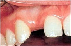 Dental_Implants_1