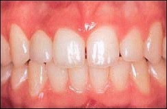 Dental_Implants_2